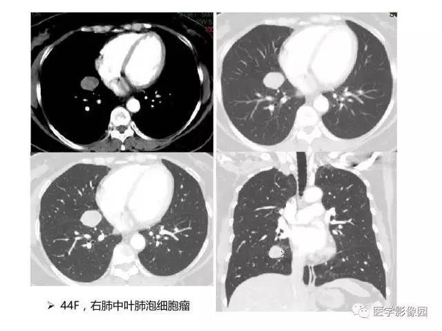 【病例】左肺门巨淋巴结增生1例CT影像分析