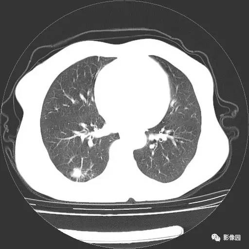 【病例】右肺下叶鳞癌1例CT