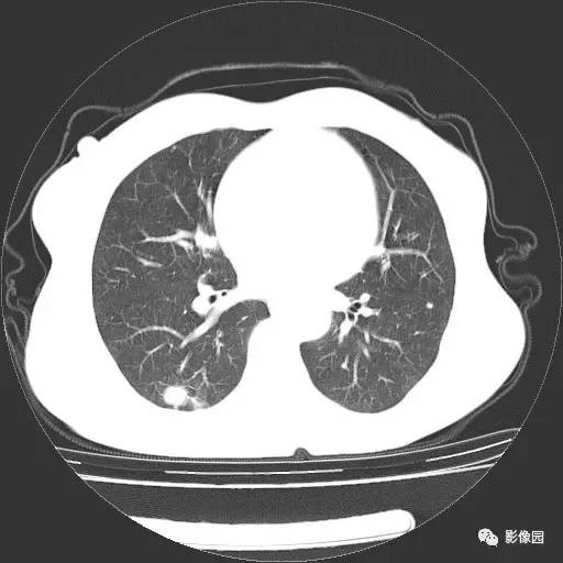 【病例】右肺下叶鳞癌1例CT