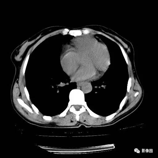 【病例】右肺下叶鳞癌1例CT