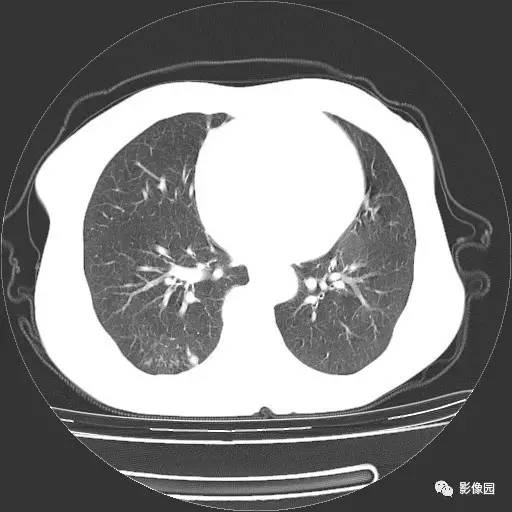【病例】右肺下叶鳞癌1例CT