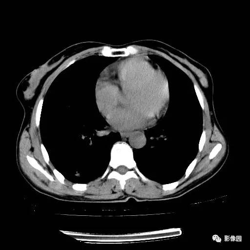 【病例】右肺下叶鳞癌1例CT
