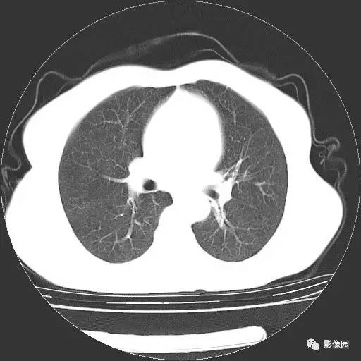 【病例】右肺下叶鳞癌1例CT