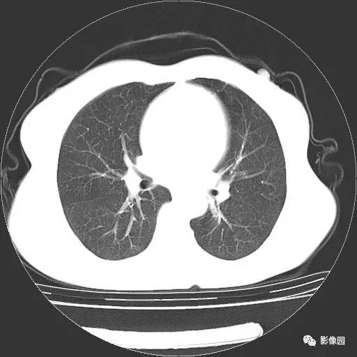 【病例】右肺下叶鳞癌1例CT