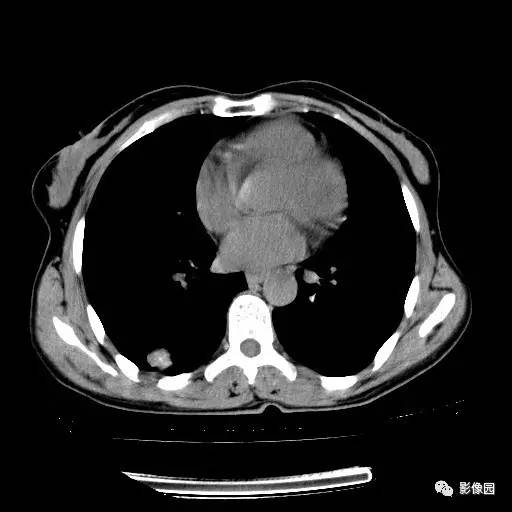 【病例】右肺下叶鳞癌1例CT