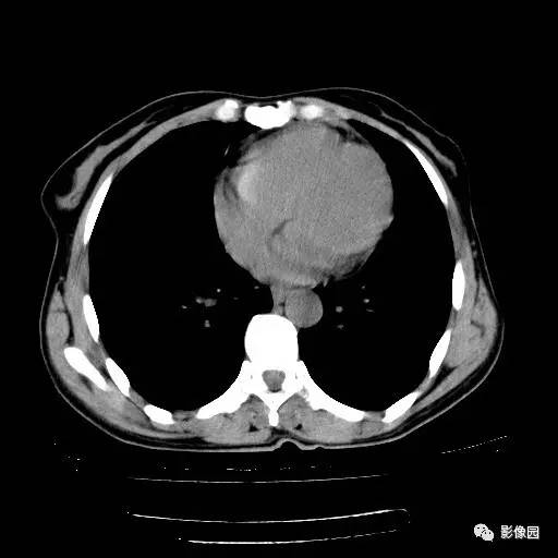 【病例】右肺下叶鳞癌1例CT