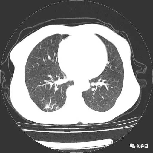 【病例】右肺下叶鳞癌1例CT