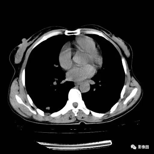 【病例】右肺下叶鳞癌1例CT