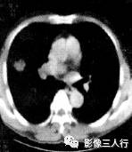 “血管切迹征” 的影像表现与临床意义 “血管切迹征” 的影像表现与临床意义