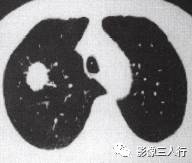 “血管切迹征” 的影像表现与临床意义