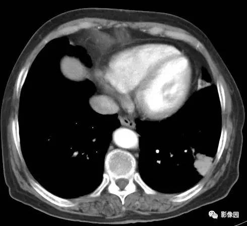 【病例】左下肺鳞癌1例CT