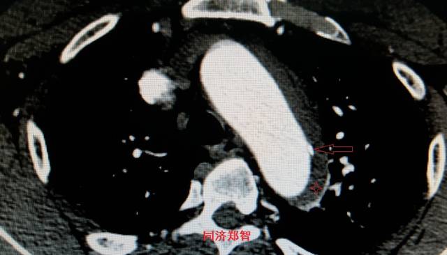 没有CTA？这三招也能识别主动脉夹层！