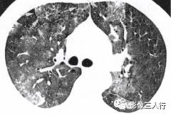 “磨玻璃征” 的影像表现与临床意义