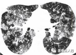 “磨玻璃征” 的影像表现与临床意义 “磨玻璃征” 的影像表现与临床意义