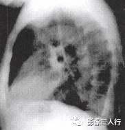 “逆S征” 的影像表现与临床意义