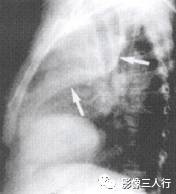 “逆S征” 的影像表现与临床意义 “逆S征” 的影像表现与临床意义