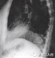 “逆S征” 的影像表现与临床意义