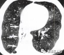 “逆S征” 的影像表现与临床意义