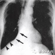 “逆S征” 的影像表现与临床意义