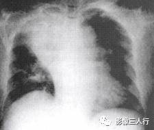 “逆S征” 的影像表现与临床意义