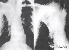 “逆S征” 的影像表现与临床意义