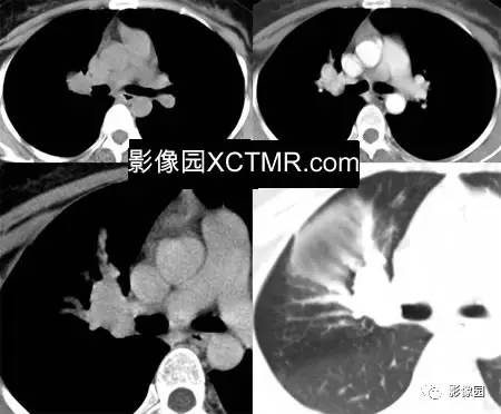 【病例】右上肺类癌1例CT影像表现