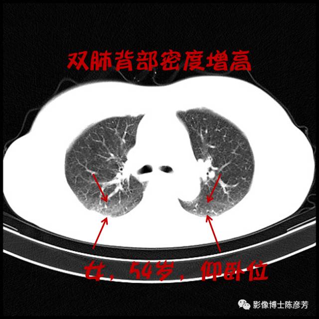 二手烟的肺竟然是这样的