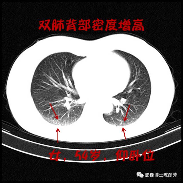 二手烟的肺竟然是这样的