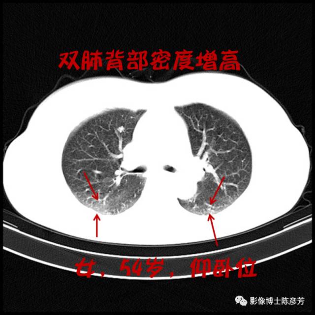 二手烟的肺竟然是这样的