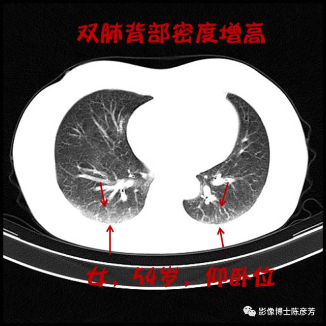 二手烟的肺竟然是这样的