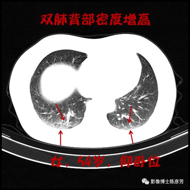 二手烟的肺竟然是这样的 二手烟的肺竟然是这样的