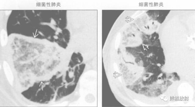 “晕征、反晕征”的鉴别诊断
