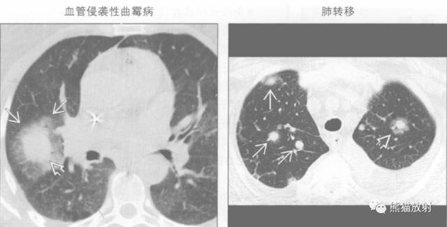 “晕征、反晕征”的鉴别诊断