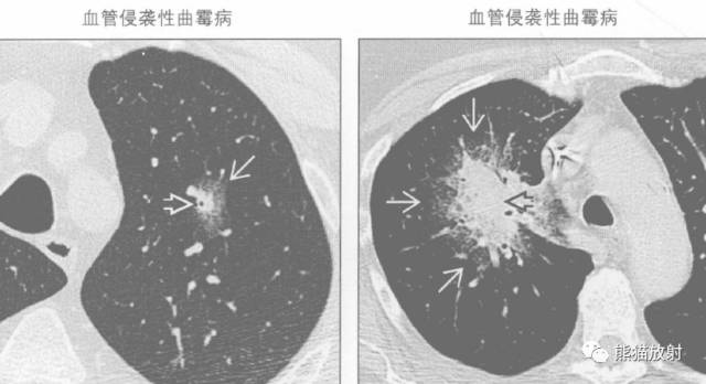 “晕征、反晕征”的鉴别诊断