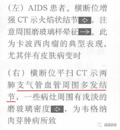 “晕征、反晕征”的鉴别诊断