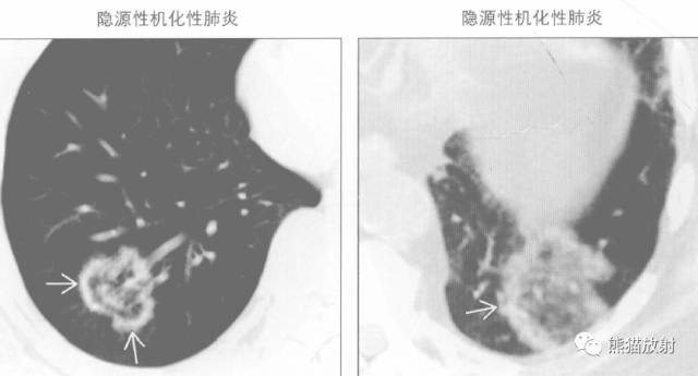 “晕征、反晕征”的鉴别诊断
