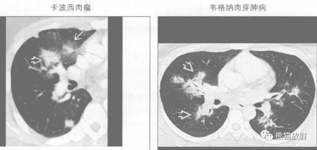 “晕征、反晕征”的鉴别诊断
