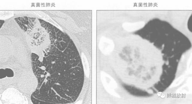 “晕征、反晕征”的鉴别诊断