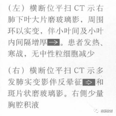 “晕征、反晕征”的鉴别诊断