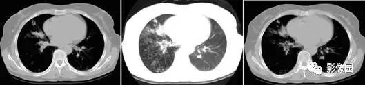 【病例】肺结核1例CT