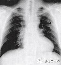 “肋骨切迹征” 的影像表现与临床意义