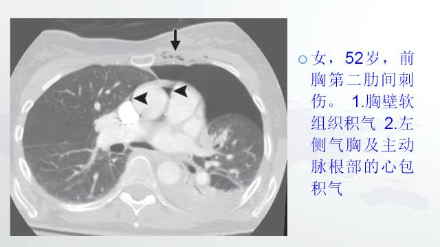 【PPT】穿透性经纵隔损伤的影像学评估 【PPT】穿透性经纵隔损伤的影像学评估