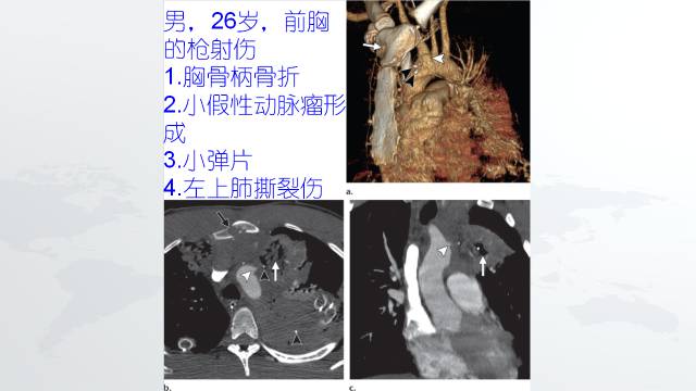 【PPT】穿透性经纵隔损伤的影像学评估 【PPT】穿透性经纵隔损伤的影像学评估