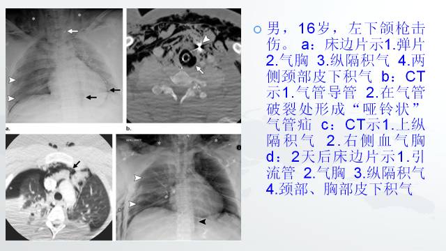 【PPT】穿透性经纵隔损伤的影像学评估 【PPT】穿透性经纵隔损伤的影像学评估