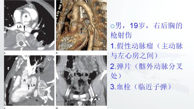 【PPT】穿透性经纵隔损伤的影像学评估 【PPT】穿透性经纵隔损伤的影像学评估