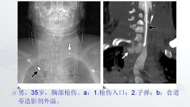 【PPT】穿透性经纵隔损伤的影像学评估 【PPT】穿透性经纵隔损伤的影像学评估