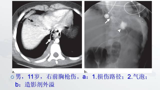 【PPT】穿透性经纵隔损伤的影像学评估 【PPT】穿透性经纵隔损伤的影像学评估