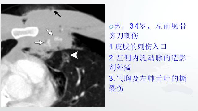 【PPT】穿透性经纵隔损伤的影像学评估 【PPT】穿透性经纵隔损伤的影像学评估