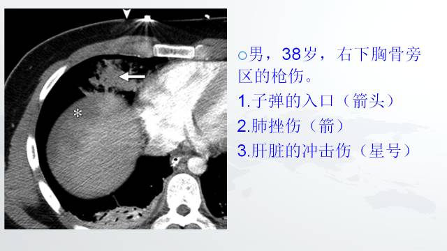 【PPT】穿透性经纵隔损伤的影像学评估 【PPT】穿透性经纵隔损伤的影像学评估