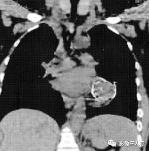 “卵壳状钙化征” 的影像表现与临床意义